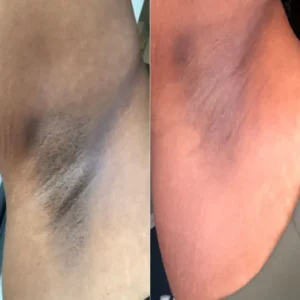Dark_spot_on_underarm_before_and_after_1080x (1)